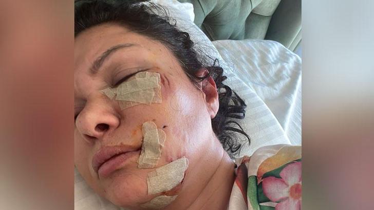 Şile'de köpek saldırısına uğrayan şarkıcı Tuğba Altıntop'un yüzüne dikiş atıldı