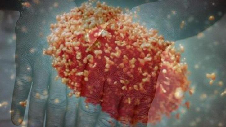 ABD’de maymun çiçeği virüsü kaynaklı ilk ölüm açıklandı