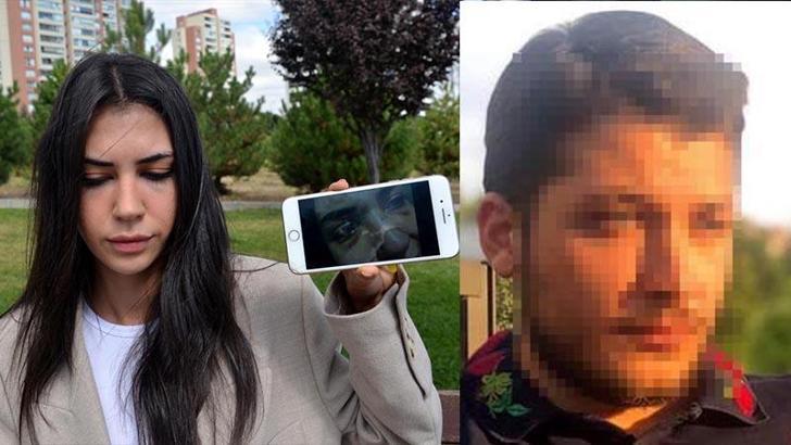 Aydan'dan burnunu kıran eski sevgilisi için elektronik kelepçe talebi