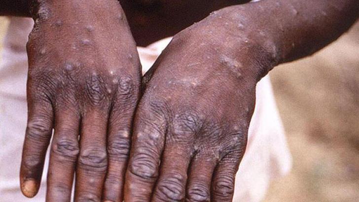 Maymun Çiçeği'nde son durum: 73 bin 437 toplam vaka, 29 kişi hayatını kaybetti