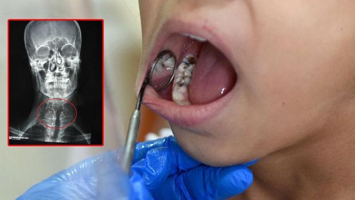 Tedavi edilmeyen diş iltihabında ölümcül 'mediastinit' riski