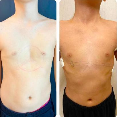 Göğsü çökük olarak dünyaya gelen Ömer, ameliyatla 10 yaşında sağlığına kavuştu