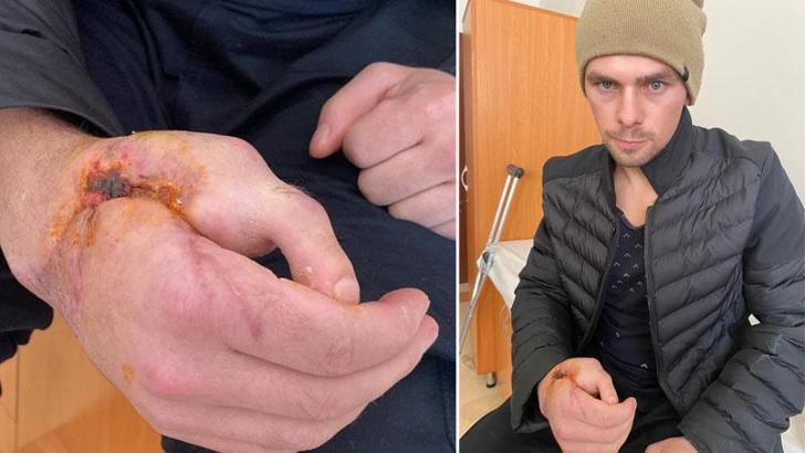 Kopan el parmağı yerine ayak parmağı dikildi