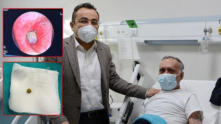 Akciğerine kaçan bezelye ameliyatla çıkarıldı