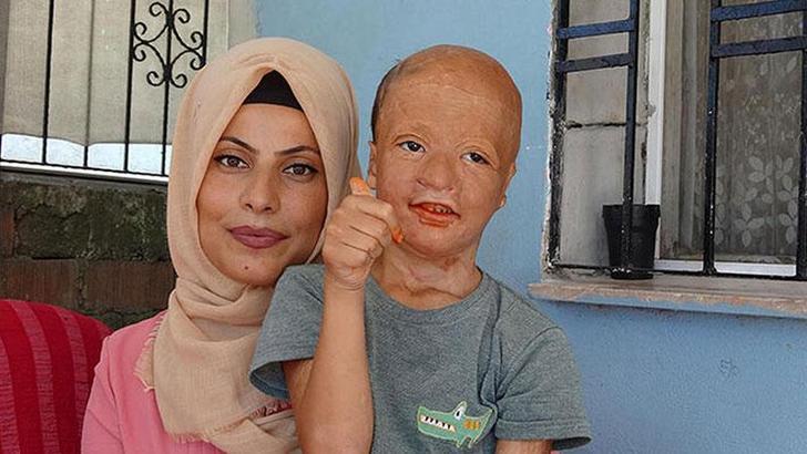 Yangında yaralanan 9 yaşındaki Halil, 3'üncü kez doku nakli için bekliyor