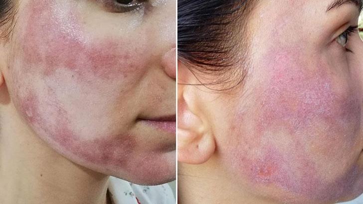 Cansu'nun yüzünü yakan güzellik merkezi sorumlularına ceza