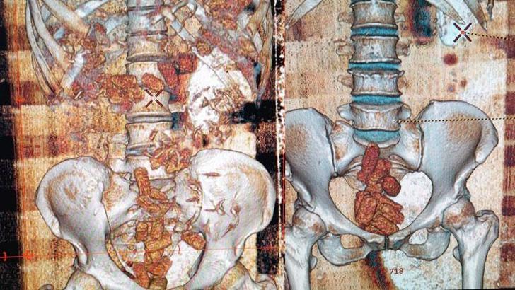 Bağırsaklarındaki uyuşturucu tomografiyle ortaya çıktı