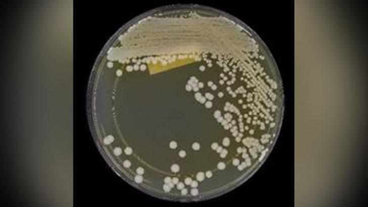 İlaca dirençli bir mantar hastalığı ABD’deki sağlık merkezlerinde yayılmaya devam ediyor