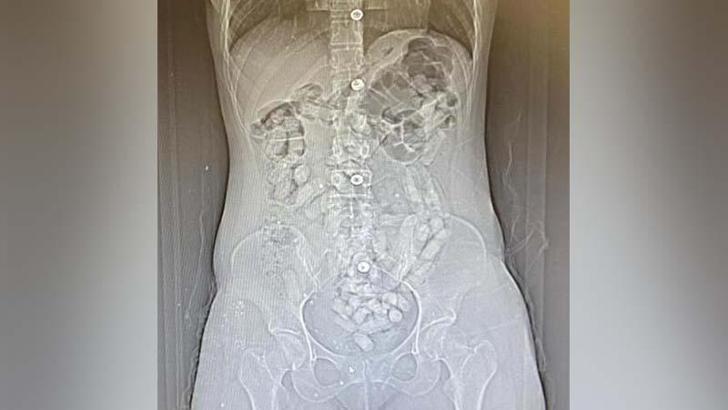 İranlı 2 kadının midelerinden 693,3 gram Afyon sakızı çıktı