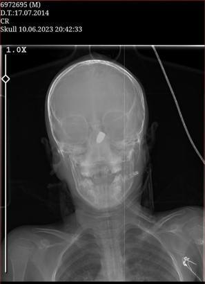 Başında mermiyle yaşam savaşı veren Kerem, erken doğan kardeşiyle aynı hastanede