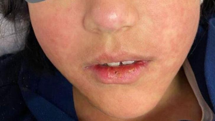 Bakan Koca: Kızamığa bağlı ölüm iddiaları asılsız