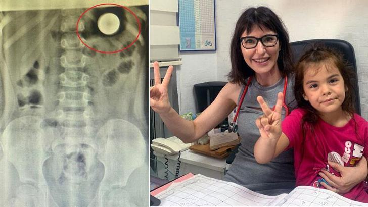 Irmak, yuttuğu madeni paradan 14'üncü günde diyetle kurtuldu