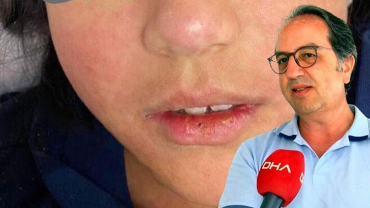 Prof. Dr. Şener, kızamıkta göçmen nüfusa karşı uyardı