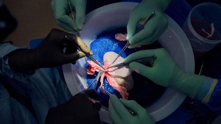 Domuz böbreği, 32 gün boyunca insan vücudunda işlevini yerine getirdi