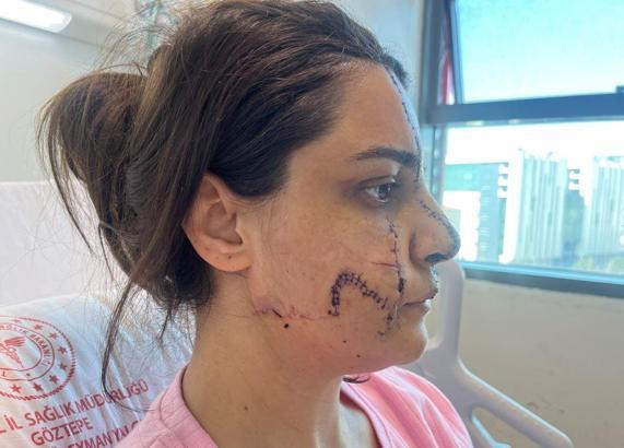 İstanbul -  Marmaray İstasyonu'nda saldırıya uğrayan kadın yüzündeki 40 dikişle dehşet dolu anları anlattı