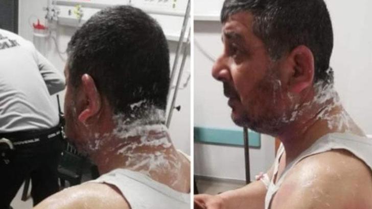 Hatay'da, tartıştığı kiracısına asitle saldırdı