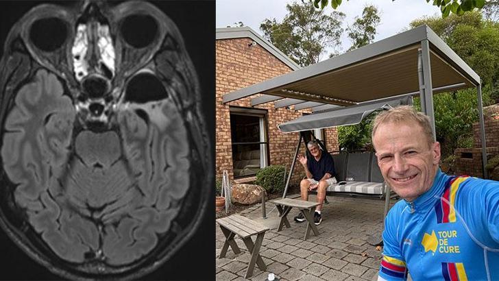 Avustralyalı doktor, beyin kanserini kendi çalışmasıyla tedavi etti