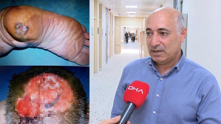 Cilt Kanseri Farkındalık Ayı'nda uzmanından uyarı; yüz bölgesindeki kanser beyne ilerleyebilir