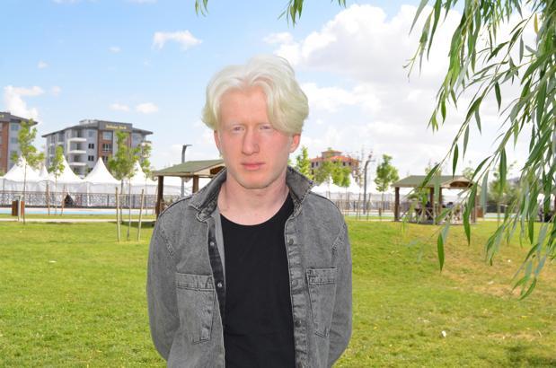Albino hastası Emirhan:  İnsanlar farklı yaklaşımlar sergileyebiliyor