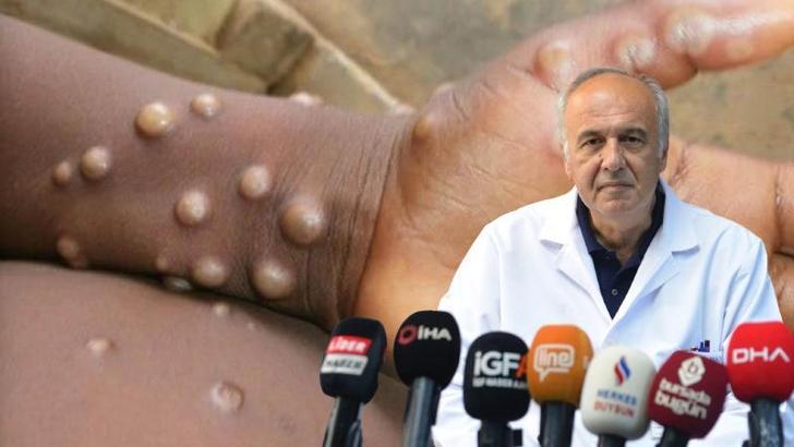 Prof. Dr. Akalın: Maymun çiçeğinde hijyen kuralları önemli