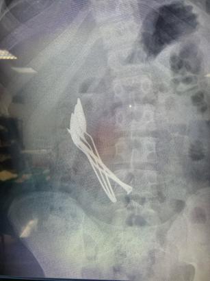 15 yaşındaki çocuğun midesinden 4 kaşık ve 1 çivi çıkarıldı