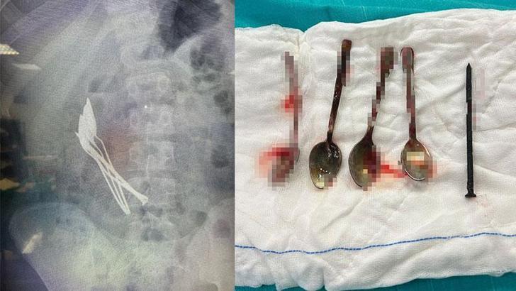 15 yaşındaki çocuğun midesinden 4 kaşık ve 1 çivi çıkarıldı