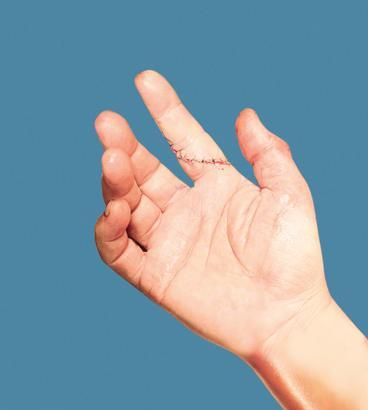 Ekol Hastanesi'nde el mikrocerrahisi dönemi başladı