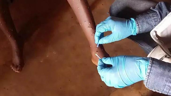 Kongo’da maymun çiçeÄŸine karşı aşılama baÅŸladı