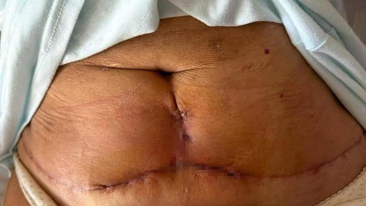 Kol ve karın germe ameliyatı oldu, dikiş izleri kaldı