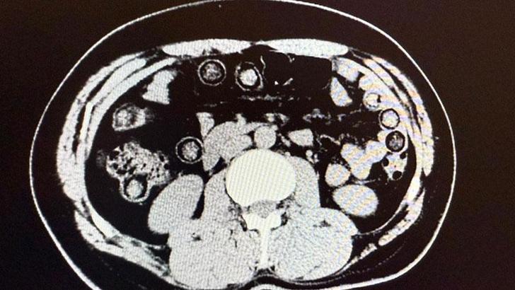 İran uyruklu 2 şüphelinin midelerinde 94 kapsül halinde metamfetamin çıkarıldı
