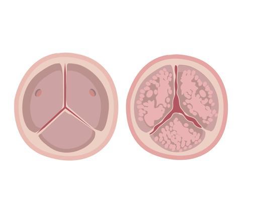 Uzmanı uyardı: Nefes darlığı ve çarpıntı kalp kapaklarındaki sorunun belirtisi olabilir