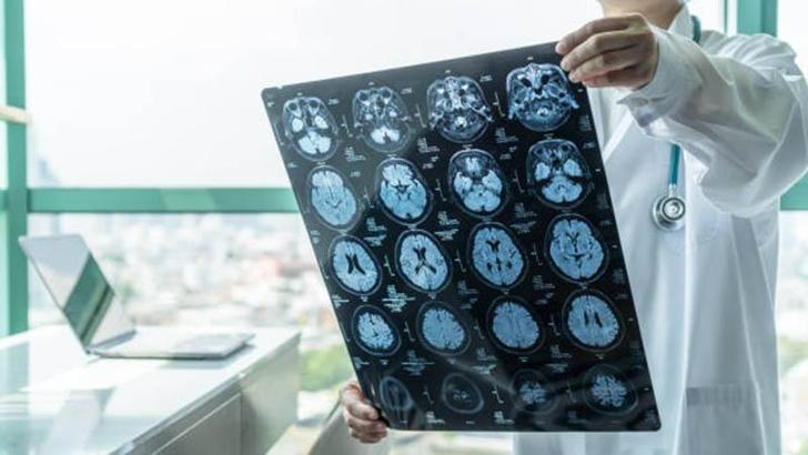 Araştırma: Bunamanın ilk belirtisi 11 yıl önce ortaya çıkıyor