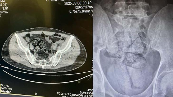 İranlı şüphelinin bağırsağından uyuşturucu çıktı