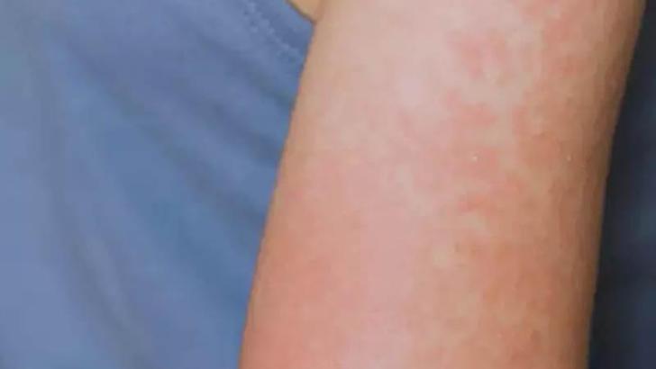 ABD'nin Teksas eyaletindeki kızamık salgınında vaka sayısı 223'e yükseldi