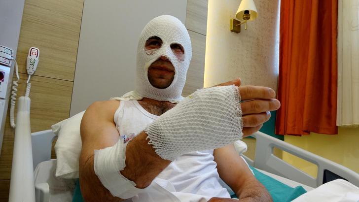 Nişanlısına hediye paketi hazırlarken patlayan sprey boya kutusu hastanelik etti