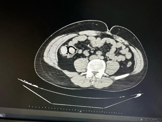 Midelerinde uyuşturucu çıkan 2 şüpheli, tutuklandı
