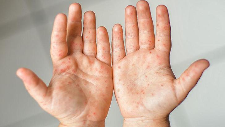 Japonya'da kızamık vakaları artıyor