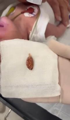 Muhammed bebeğin yemek borusuna takılan badem şekeri, operasyonla çıkarıldı