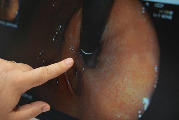 ‘Bağırsak hastalıkları doğru tedavi ve beslenme ile kontrol altına alınabilir’