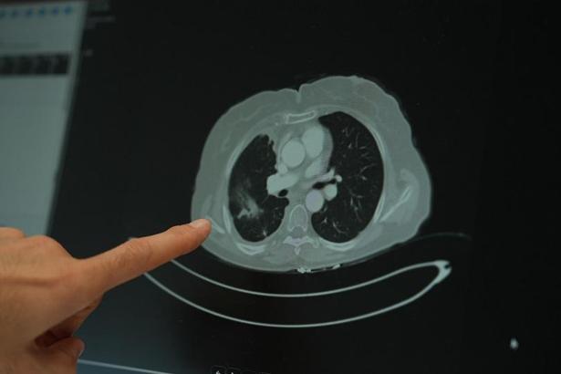 ‘Genç yaş grubunda kanser vakalarında artış yaşanıyor’