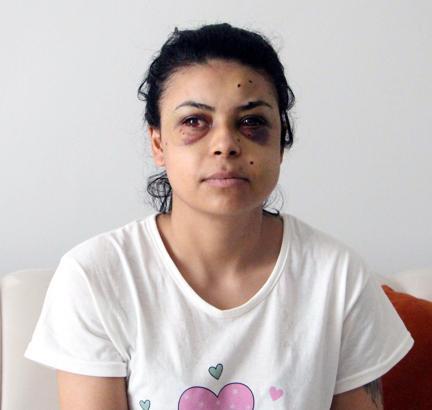 Düğünde tüfekle ateş açıldı, penceredeki Nazar gözlerinden yaralandı