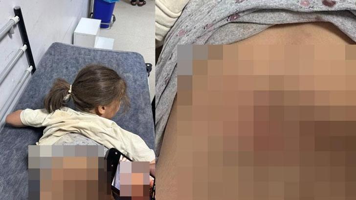 Sokak köpeklerinin saldırısına uğrayan Zeynep, yaralandı