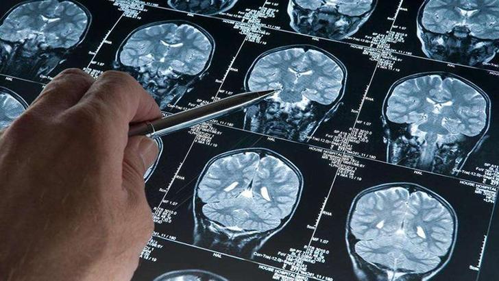 Alzheimer hastalığını erken evrede tespit edebilen kan testi geliştirildi