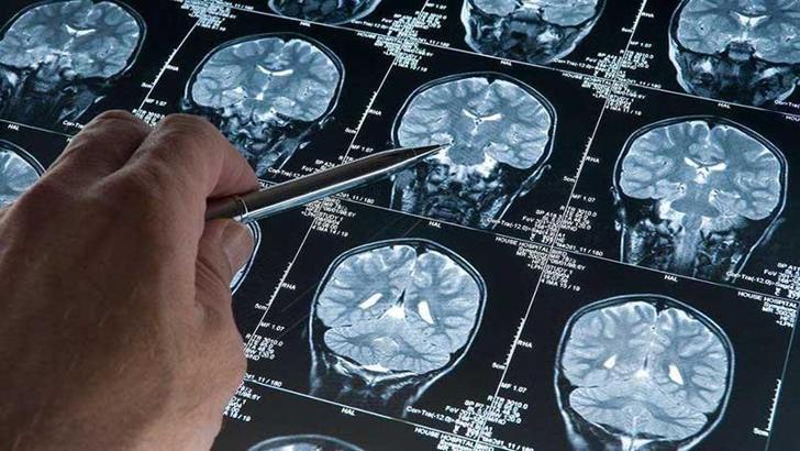 Alzheimer araştırmalarında riski artıran genetik varyant bulundu