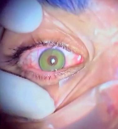 Göz rengini kalıcı olarak değiştirmek mümkün; en çok mavi ve yeşil uygulanıyor