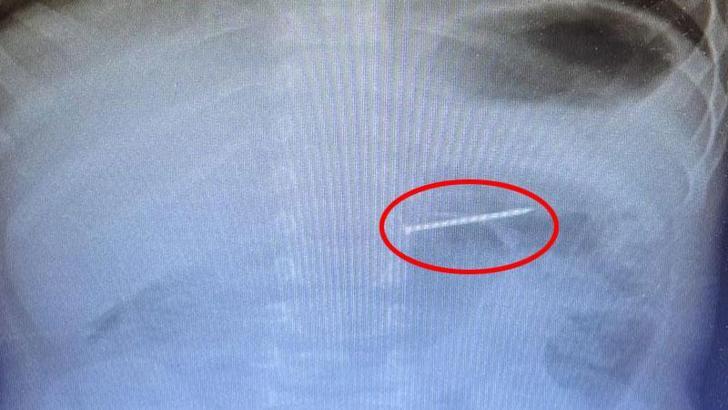 2 yaşındaki bebeğin yuttuğu çivi midesinden çıkarıldı