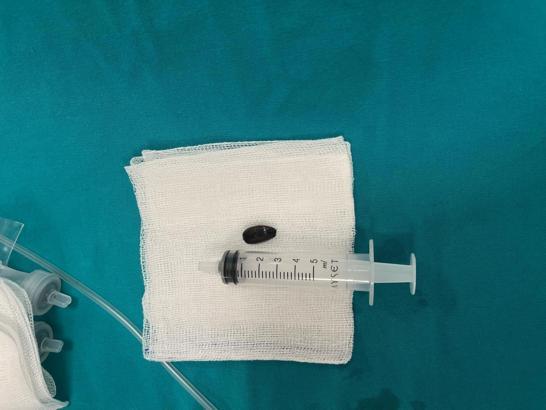 Nefes borusuna çekirdek kabuğu kaçan bebek ameliyatla sağlığına kavuştu