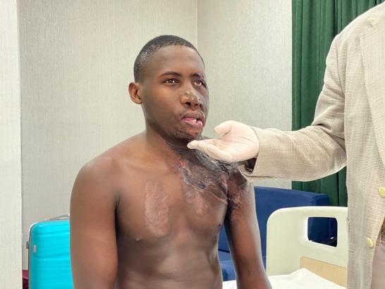 Yüzü yanan Ugandalı çoban Ankara'da tedavi edildi