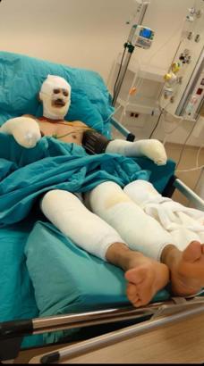 Orman yangınına müdahale sırasında ağır yaralanan eşinin son halini paylaştı