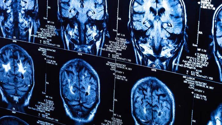 Araştırma: Covid-19 beyni yaşlandırdı